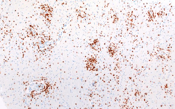 4C1 Lymphohistiocytosis (Case 4) CD3 N3 10X