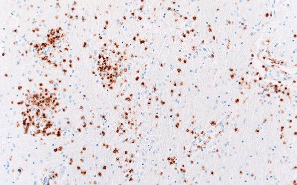 4C2 Lymphohistiocytosis (Case 4) CD3 N3 20X