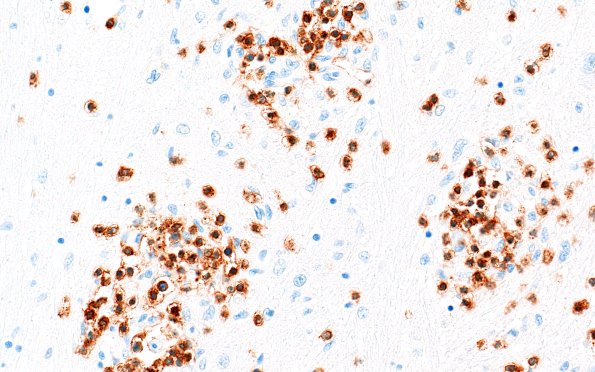 4C3 Lymphohistiocytosis (Case 4) CD3 N3 40X