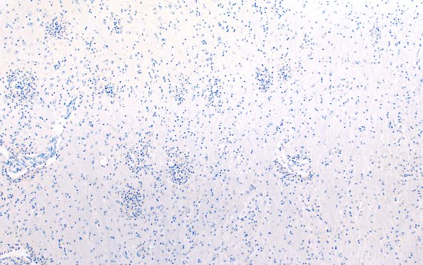 4D Lymphohistiocytosis (Case 4) CD20 N3 10X
