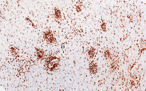 4E1 Lymphohistiocytosis (Case 4) CD68 N3 10X