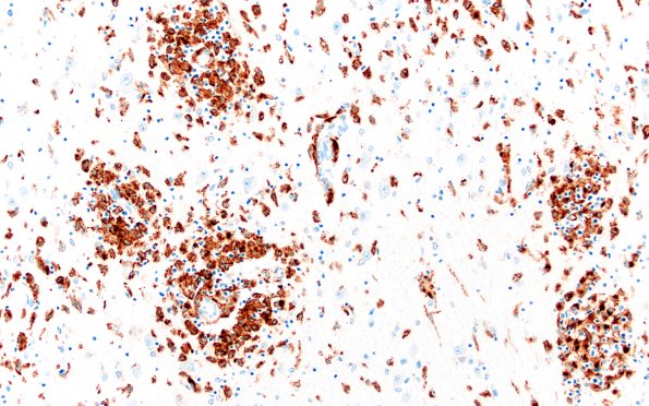 4E2 Lymphohistiocytosis (Case 4) CD68 N3 20X
