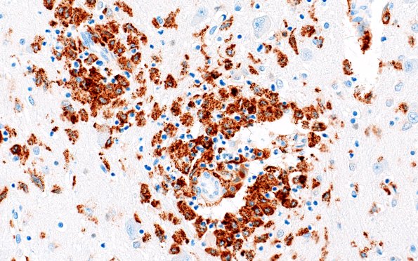 4E3 Lymphohistiocytosis (Case 4) CD68 N3 40X