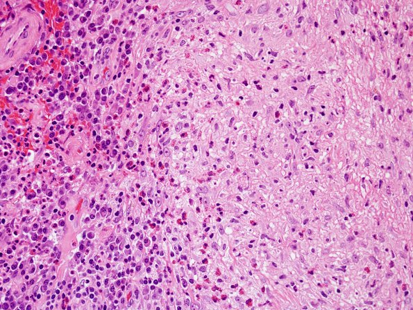 1A6 Bovine dural graft reaction (Case 1) H&E 8