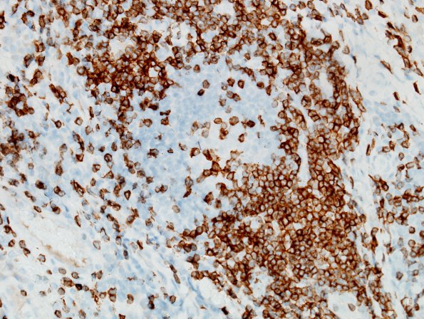 1B2 Bovine dural graft reaction (Case 1) CD3 3