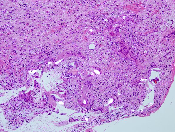 2A1 Foreign body reaction, textiloma (Case 2) H&E 2B