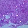 2A2 Foreign body reaction, textiloma (Case 2) H&E 2A