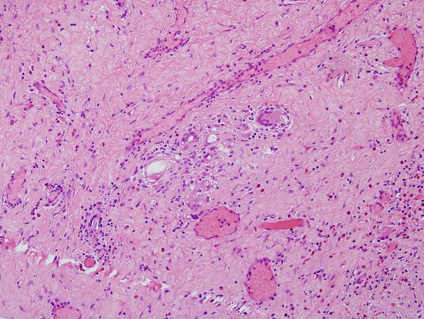 2B1 Foreign body reaction, textiloma (Case 2) H&E 5B