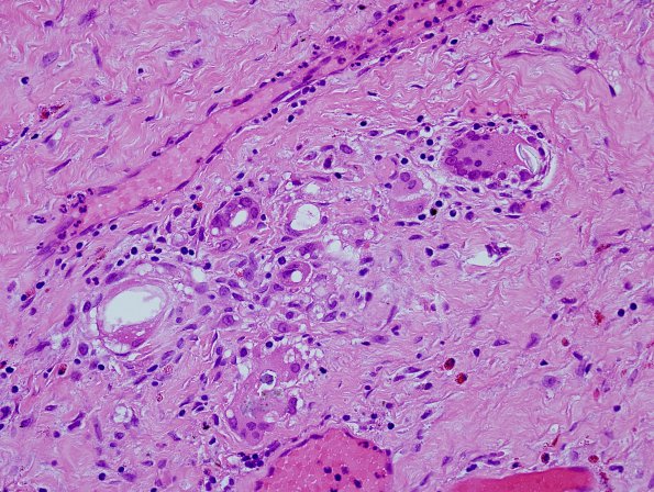 2B3 Foreign body reaction, textiloma (Case 2) H&E 4A