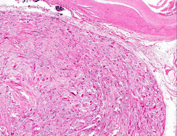 4A2 Foreign Body Reaction (post-surgery, cotton AANP 1969, Case 1) H&E X4 1