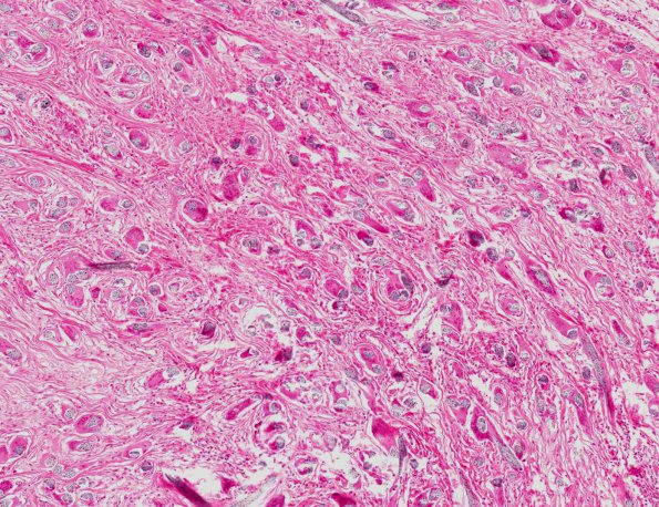 4A3 Foreign Body Reaction (post-surgery, AANP 1969, Case 1) H&E X10 1