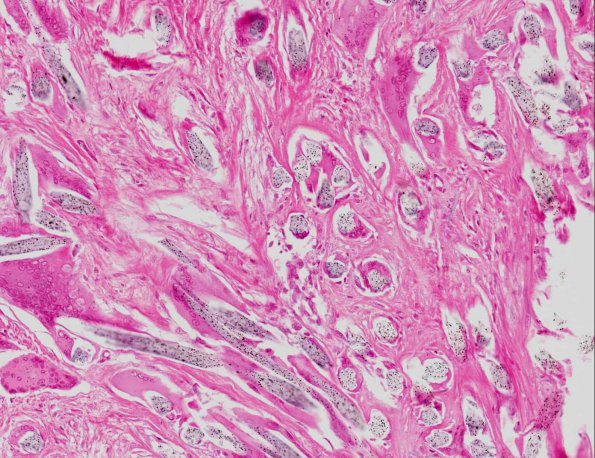 4A4 Foreign Body Reaction (post-surgery, AANP 1969, Case 1) H&E X20 4