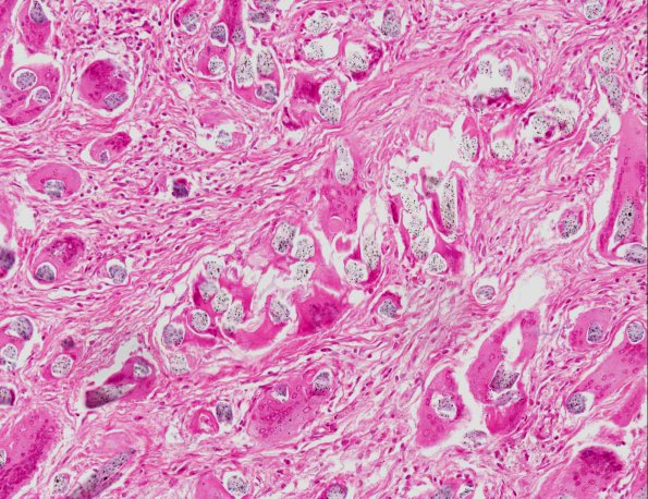 4A5 Foreign Body Reaction (post-surgery, AANP 1969, Case 1) H&E X20 5