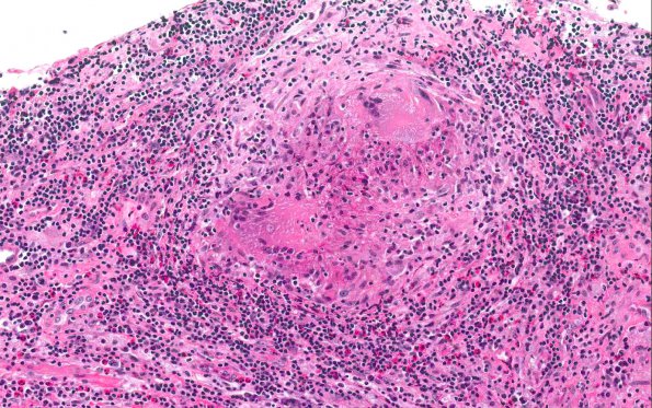 5A1 Gelfoam, granulomatous reaction (AANP 2015 Case 1) H&E 18.8X 1