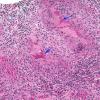 5A2 Gelfoam, granulomatous reaction (AANP 2015 Case 1) H&E 18