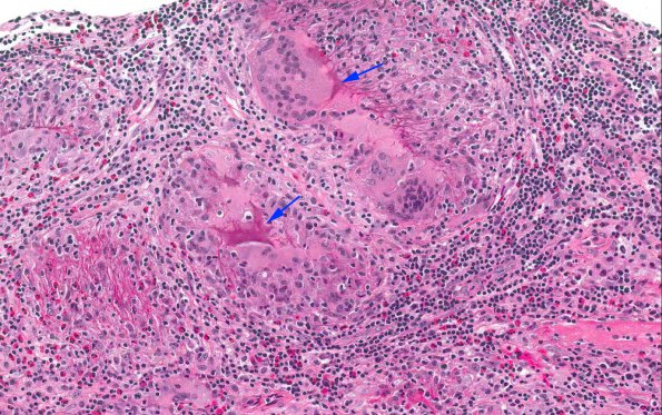 5A2 Gelfoam, granulomatous reaction (AANP 2015 Case 1) H&E 18