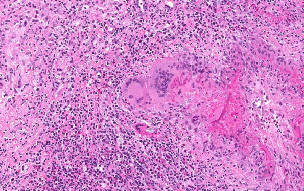 5A3 Gelfoam, granulomatous reaction (AANP 2015 Case 1) H&E 18.8X 4