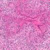 5A4 Gelfoam, granulomatous reaction (AANP 2015 Case 1) H&E 18.8X 3