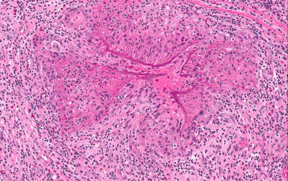 5A4 Gelfoam, granulomatous reaction (AANP 2015 Case 1) H&E 18.8X 3