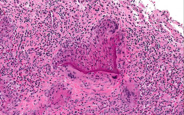 5A5 Gelfoam, granulomatous reaction (AANP 2015 Case 1) H&E 18.8X 5