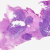 6A1 History Gossypiboma cotton prior surgery metastasis (Case 6) H&E whole mount 1