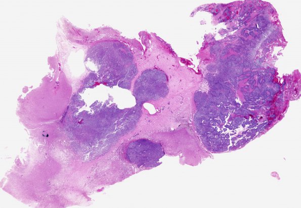 6A1 History Gossypiboma cotton prior surgery metastasis (Case 6) H&E whole mount 1