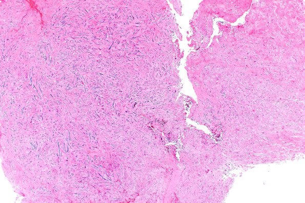 7A1 Gossypiboma, textiloma (Case 7) H&E 2X A