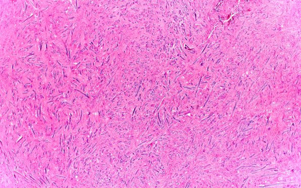 7A2 Gossypiboma, textiloma (Case 7) H&E 4X