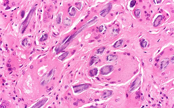 7A5 Gossypiboma, textiloma (Case 7) H&E 40X 1