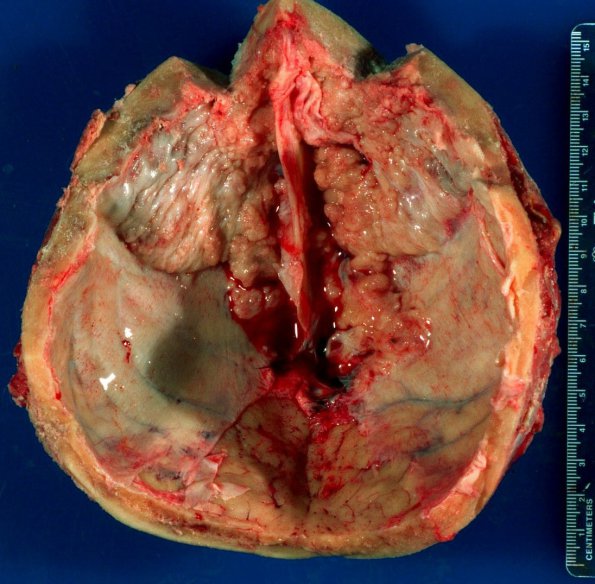 1A1 Hyperostosis frontalis interna (Case 1)_1