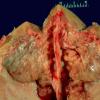 1A2 Hyperostosis frontalis interna (Case 1)_2