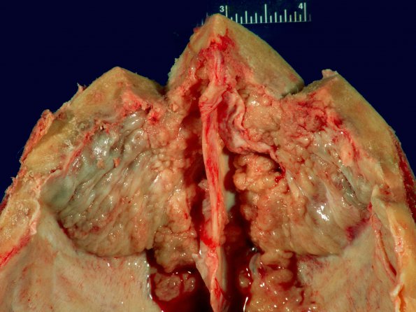 1A2 Hyperostosis frontalis interna (Case 1)_2