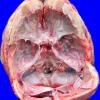 1A3 Hyperostosis frontalis interna (Case 1)_3