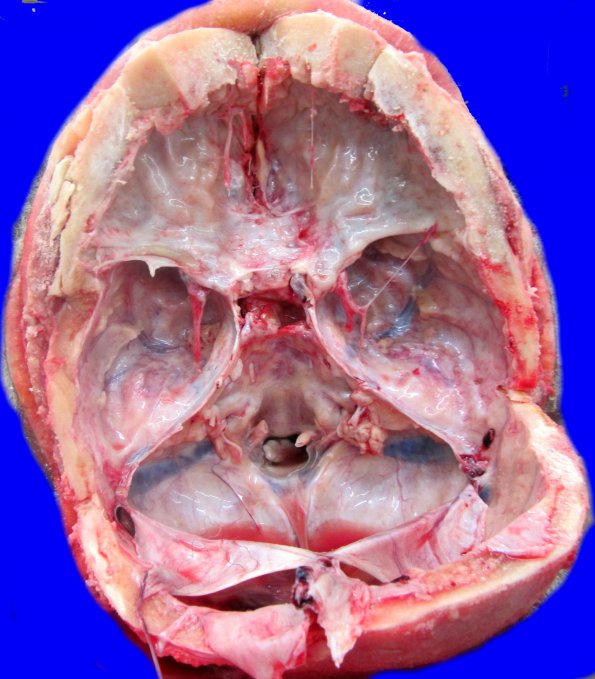 1A3 Hyperostosis frontalis interna (Case 1)_3