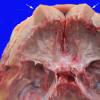 1A4 Hyperostosis frontalis interna (Case 1)_5 copy