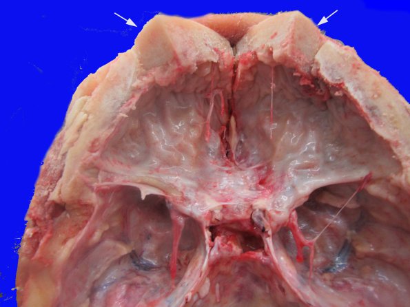 1A4 Hyperostosis frontalis interna (Case 1)_5 copy