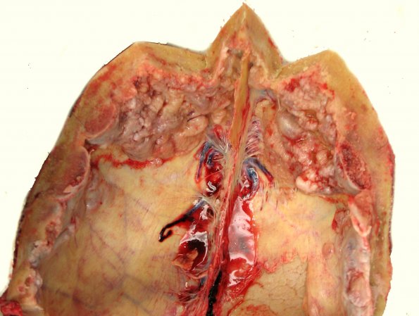 2A1 Hyperostosis frontalis interna (Case 2)_1