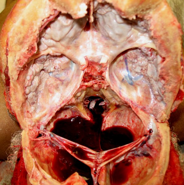 2A2 Hyperostosis frontalis interna (Case 2)_3