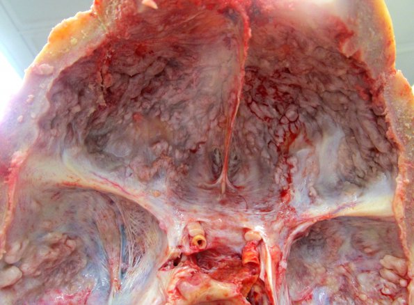 3A1 Hyperostosis frontalis interna (Case 3) _1