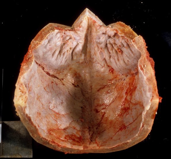 4A1 Hyperostosis frontalis interna (Case 4) 2