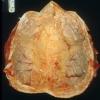 5A1 Hyperostosis frontalis interna (Case 5)