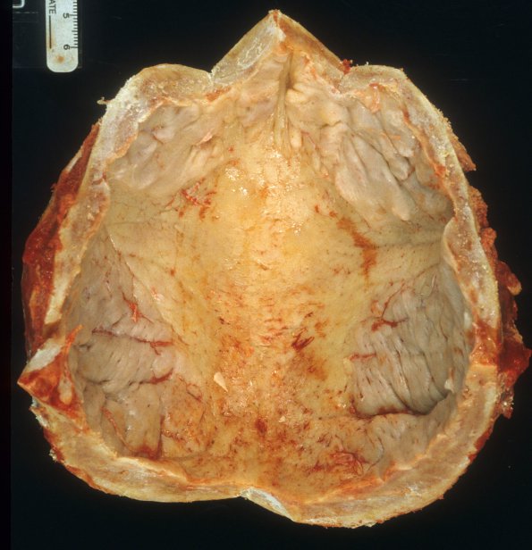 5A1 Hyperostosis frontalis interna (Case 5)