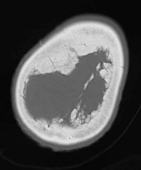 6A1 Hyperostosis frontalis interna (Case 6) CT 3 - Copy