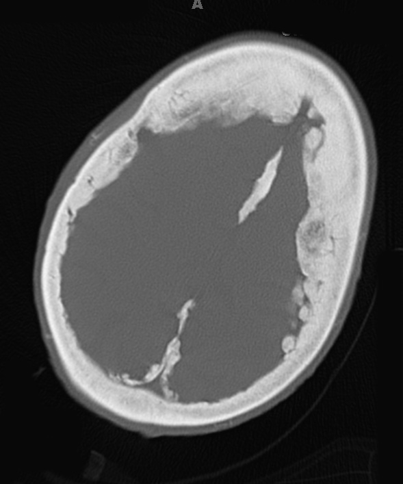 6A2 Hyperostosis frontalis interna (Case 6) CT 1 - Copy