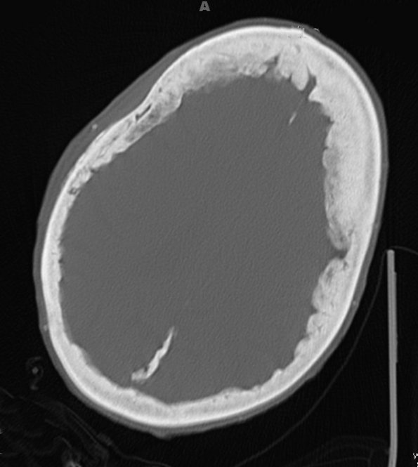 6A3 Hyperostosis frontalis interna (Case 6) CT 2 - Copy