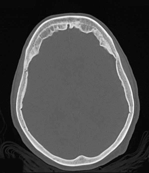 7A1 Hyperostosis frontalis interna (Case 7) CT bone window - Copy