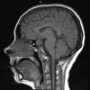 Hypophysitis - Granulomatous