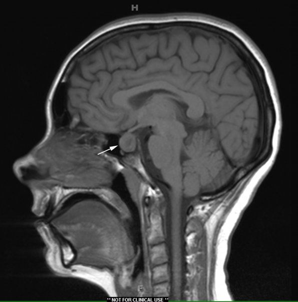 1A1 Granulomatous Hypophysitis (Case 1) T1 no contrast 2 copy - Copy