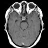 1A2 Granulomatous Hypophysitis (Case 1) T1 with contrast 2 - Copy