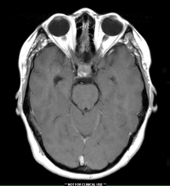 1A2 Granulomatous Hypophysitis (Case 1) T1 with contrast 2 - Copy